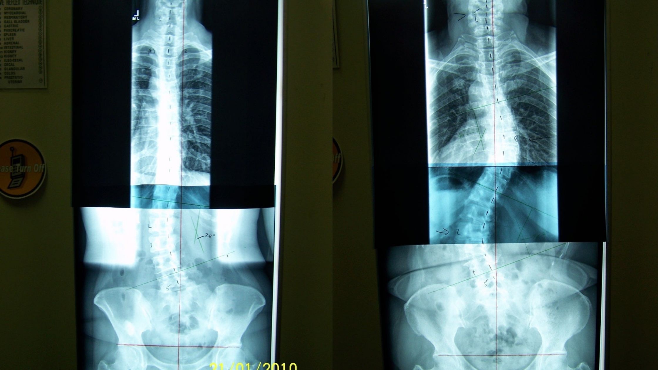 Can spinal problems be genetic?
